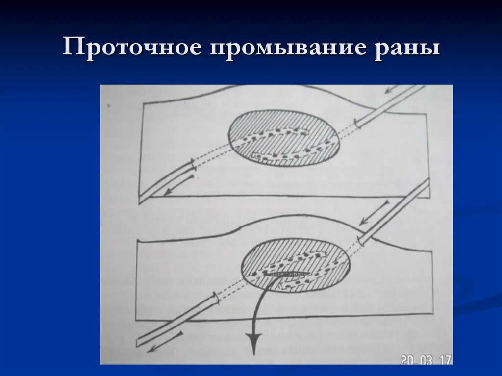 Можно промывать рану водой. Проточное промывание раны. Промывание раны проточной водой. Активное промывание раны.