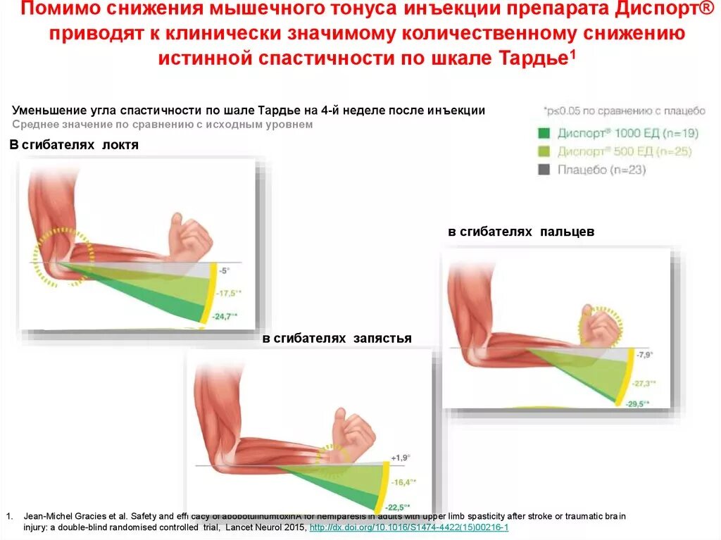 Понижение тонуса мышц. Снижение мышечного тонуса. Гипертонус мышц. Мышца в гипертонусе.