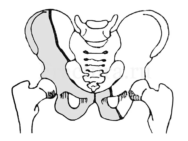 перелом верхней и нижней ветвей лобковой кости. переломы костей тазового кольца с нарушением его непрерывности. перелом лонной кости таза без смещения. перелом лобковой кости таза рентген. перелом таза лонной кости рентген.