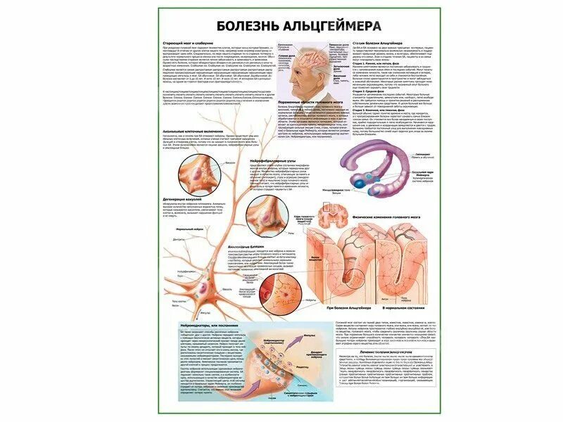 Болезнь Альцгеймера плакат. Плакаты о болезнях. Медицинские плакаты болезней. Плакаты по неврологии.