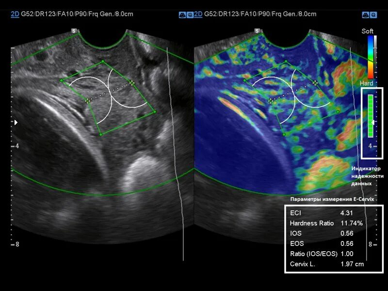 Компрессионная эластография молочных желез. Трансвагинальная эластография. Эластография мочевого пузыря. Эластография молочных желез протокол.