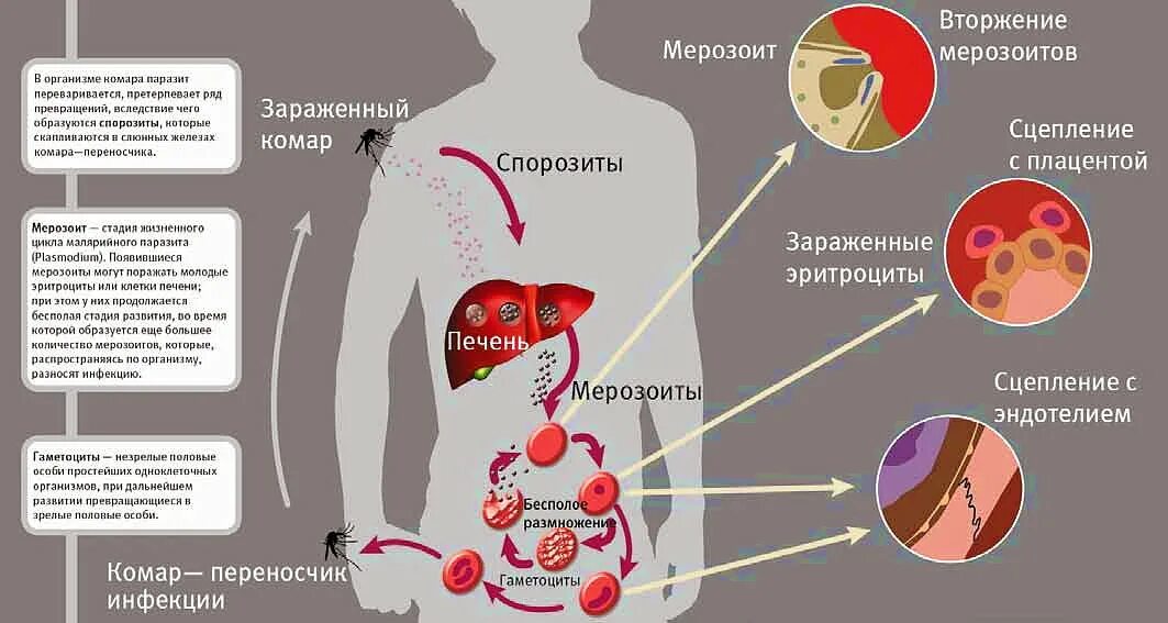 Как происходит заражение человека малярийным плазмодием. Малярийный плазмодий это бактерия. Малярийный плазмодий заболевание. Симптомы болезни малярийного плазмодия. Симптомы заражения малярийного плазмодия.