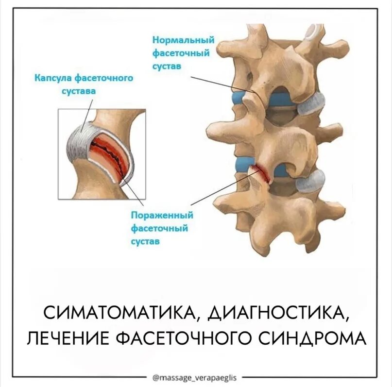 Блокада фасеточных суставов поясничного отдела. Фасеточные суставы поясничного отдела позвоночника. синдром фасеточных суставов.