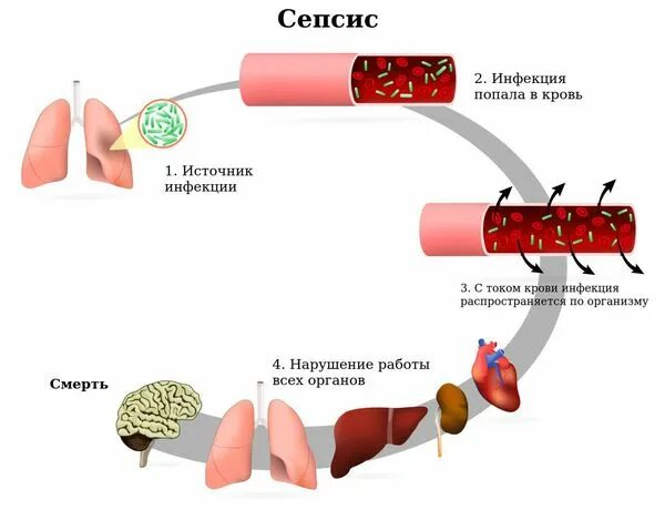 Воды попали в кровь. Септические осложнения. СИПСС.