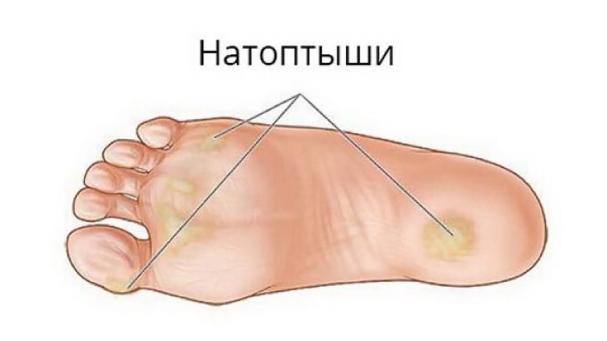 Подушечки на стопе ноги. Подошвенная сухая мозоль. Мозоль натоптыш на пальце ноги. Натоптыши на подушечке стопы.