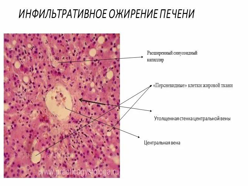 Печень микропрепарат описание. Жировая дистрофия печени гусиная печень микропрепарат. Жировая дистрофия печени гистология. Жировая дистрофия печени патанатомия макропрепарат. Жировая дистрофия печени гистология препарат.