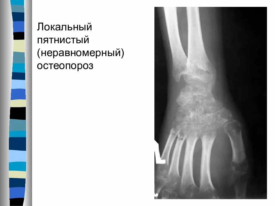 Рентген признаки остеопороза костей. Пятнистый остеопороз бедренной кости. Остеопороз кости рентген. Местный остеопороз рентген. Неравномерная диффузная