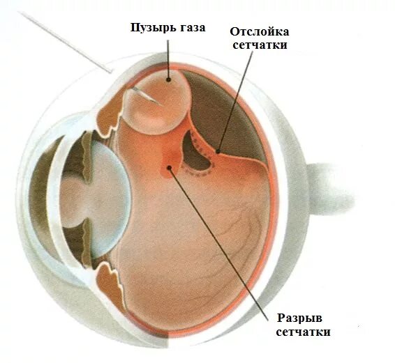 Витрэктомия при отслойке сетчатки. Глазное дно отслоение сетчатки. Субклиническая отслойка сетчатки. Отслоение сетчатки клиника.
