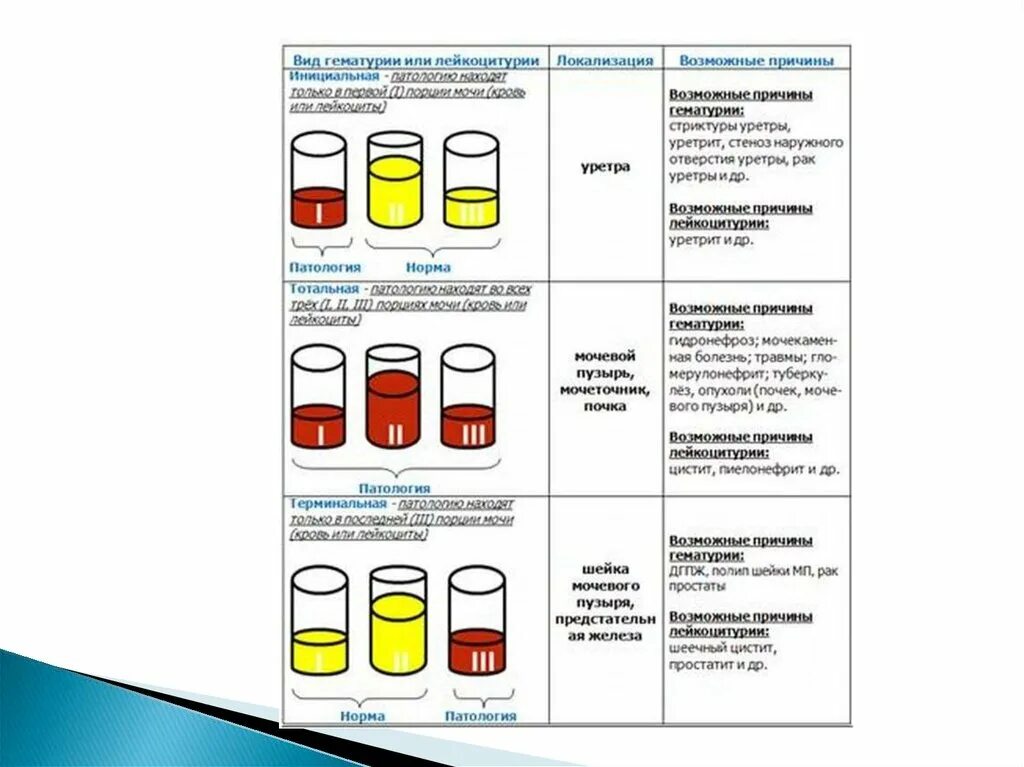 Гематурия пиурия. Вид гематурии при цистите. Гематурия виды причины. Гематурия классификация и причины. Трехстаканная проба мочи
