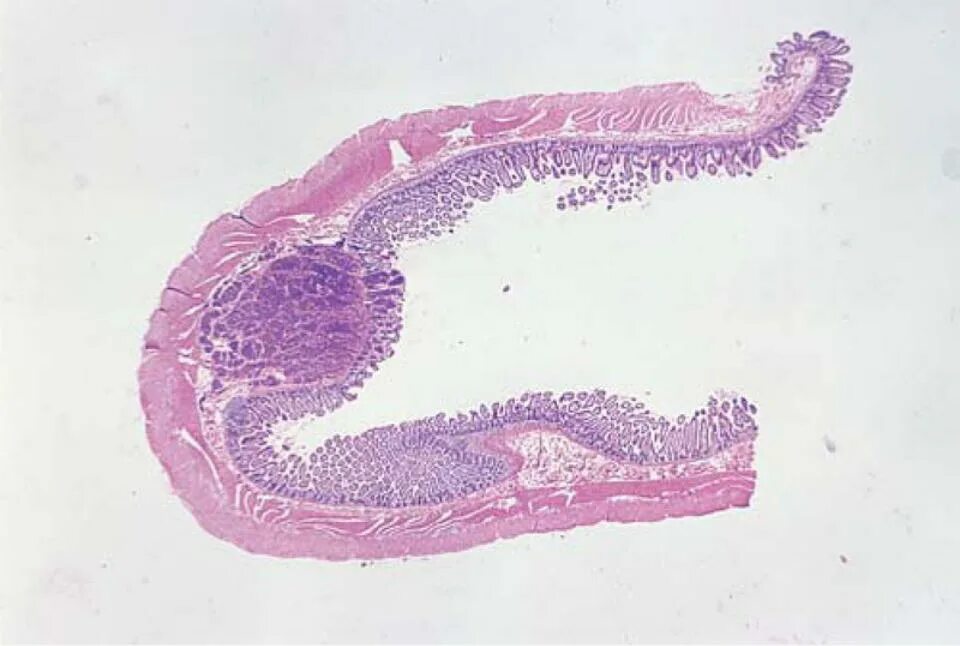 Карциноид кишечника гистология. Карциноид толстой кишки гистология. Карциноид червеобразного отростка гистология. Карциноид Толстого кишечника гистология.
