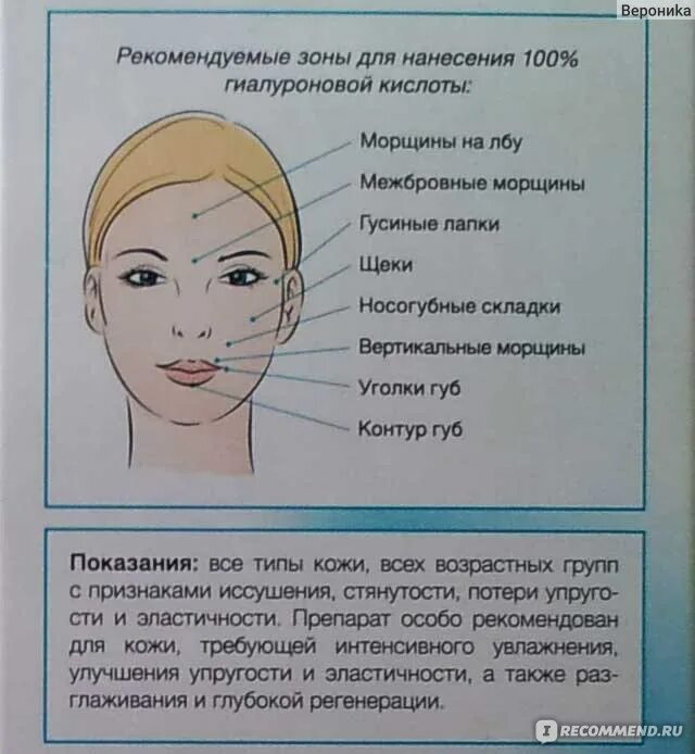 Как часто можно колоть лицо. Зоны введения гиалуроновой кислоты. уколы гиалуроновой кислоты в лицо схема. схема уколов гиалуроновой кислоты для лица. биоревитализация схема введения.
