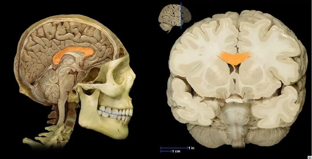 Пластина мозга. Мазолистоетело головного мозга. Большие полушария головного мозга мозолистое тело. Corpus callosum.