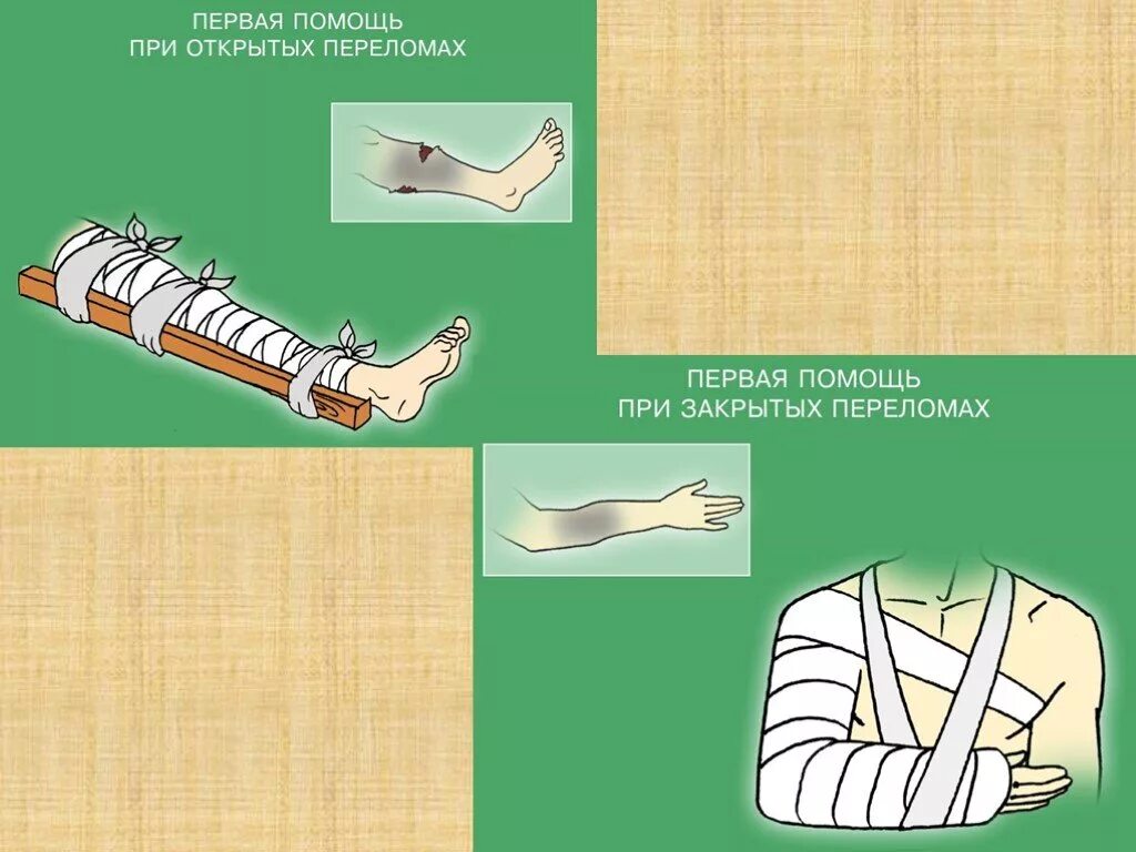 Последовательность при открытом переломе тест. Оказание первой помощи при открытом и закрытом переломе. Первая помощь при закрытых переломах. Перевязка при открытом переломе. ПМП при переломах открытых и закрытых.