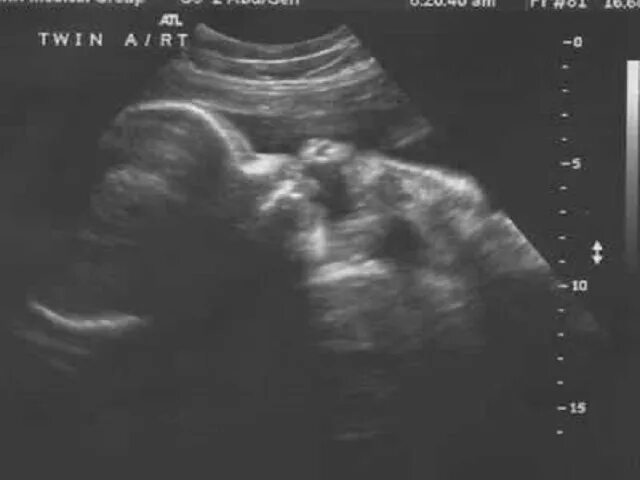 Почему на 32 неделе. Снимок УЗИ 32 недели беременности. 32 Недели беременности фото плода на УЗИ. УЗИ 32-33 недели беременности. Фото УЗИ 32 недели беременности девочка.