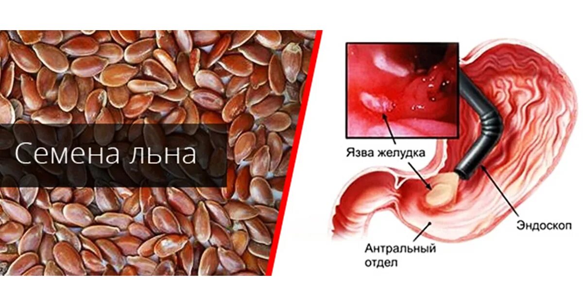 Семена льна для желудка. Семена льна от язвы желудка. Семена льна для желудка и кишечника. Семя льна от желудка. Семена льна при язве