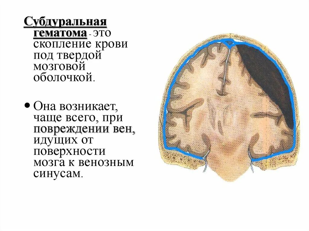 Субдуральная и эпидуральная гематома. Закрытая черепно мозговая травма субдуральная гематома. Гематома намета мозжечка. Гематома под твердой мозговой оболочкой.