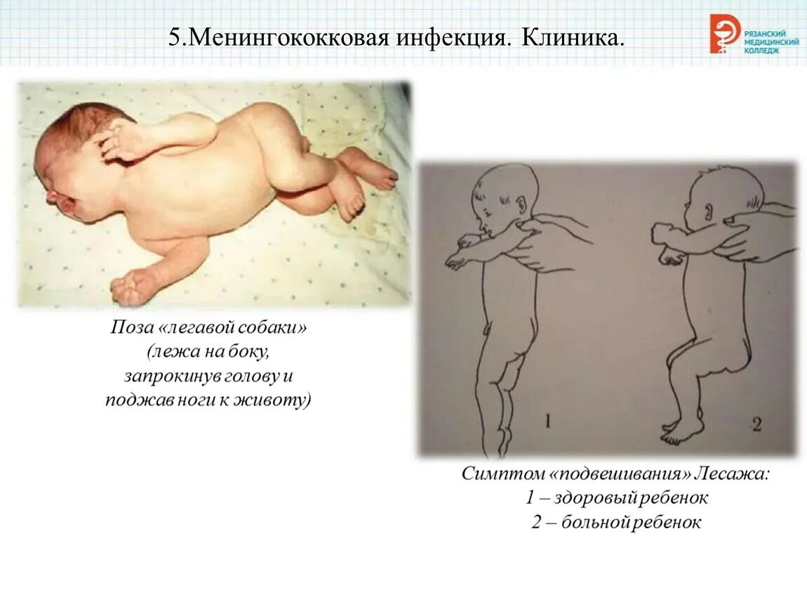 Для менингококковой инфекции характерны. Менингококковая клиника. Менингококковая инфекция у детей клиника. Клиника при менингококковой инфекции.