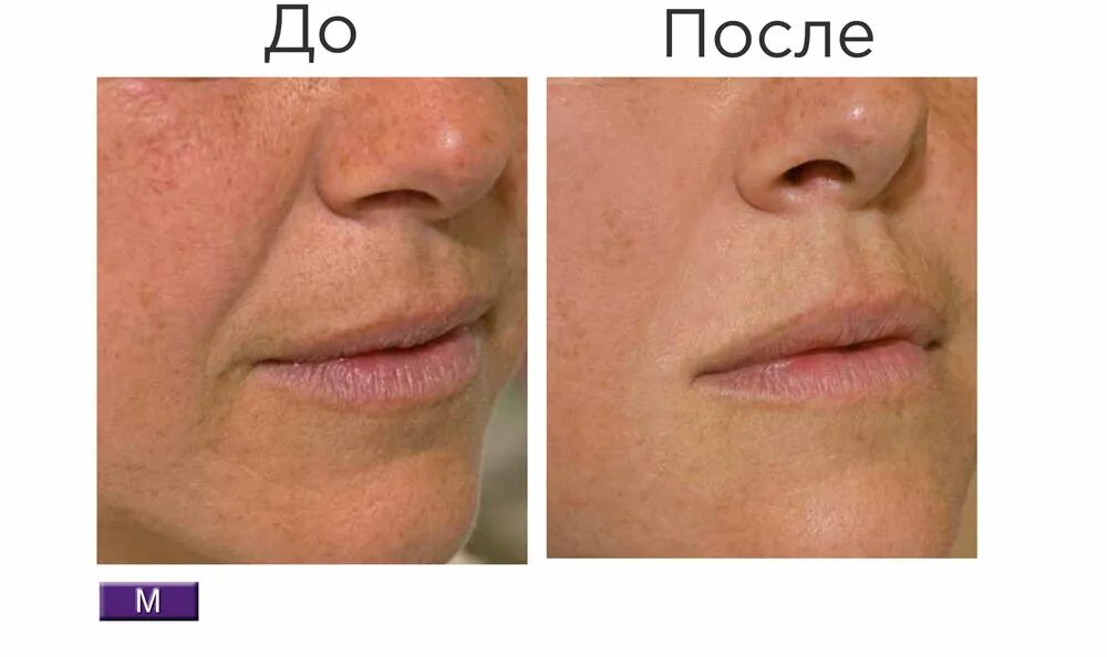 Ботокс половых. Ботокс половых