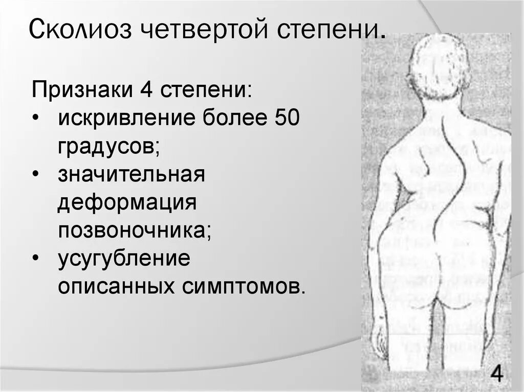 Искривление позвоночника 50 градусов. Искривление позвоночника сколиоз 1 стадия. Искривление позвоночника 4 степени. Сколиоз третьей степени симптомы.