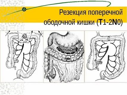 Поперечно ободочная кишка