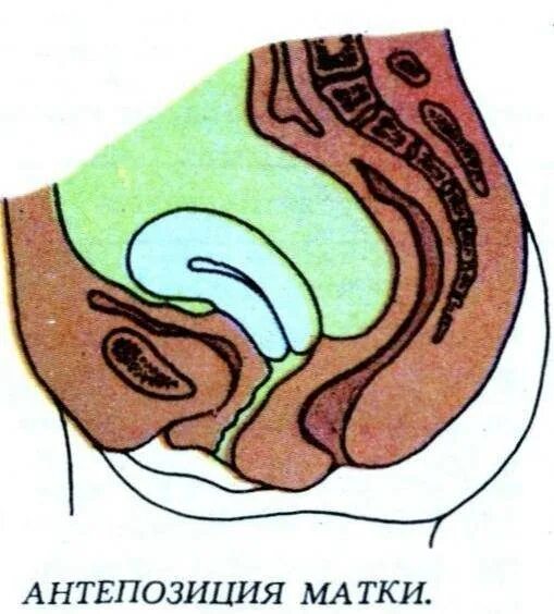 Матка антефлексио. Перегиб матки anteflexio. Загиб матки антефлексио. Загиб матки кзади.