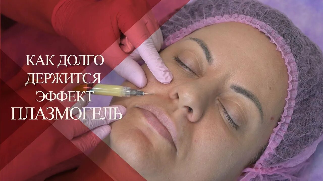 Плазмагель. Плазмагель. Prp плазмолифтинг. Коррекция носослезной борозды. Prp терапия в косметологии.