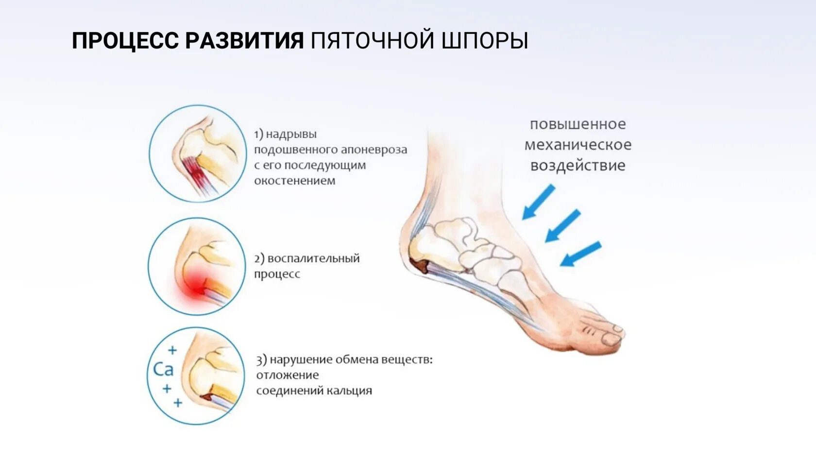 Отложение в пятке. Тыльная пяточная шпора. Подошвенный (плантарный) фасциит клиника. Шпора причины возникновения.