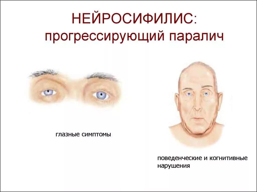 Нейросифилис это простыми словами. Прогрессивный паралич (сифилис мозга) симптомы. Нейросифилис прогрессивный паралич. Нейросифилис клинические проявления. Начальная стадия прогрессивного паралича.