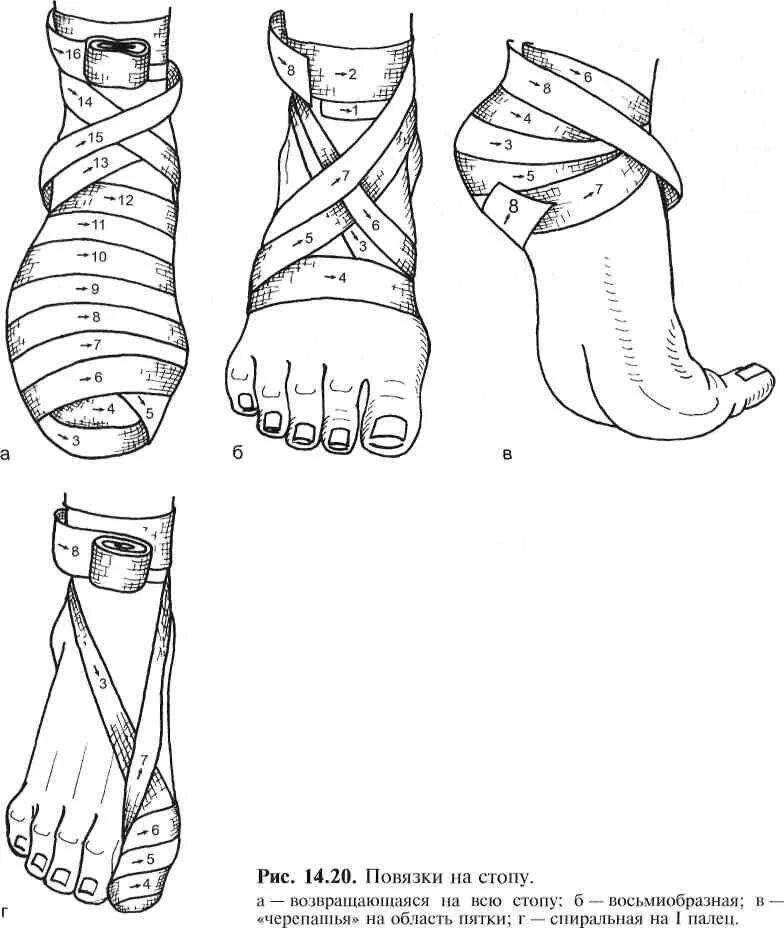 Бинтование ног эластичным бинтом алгоритм. Технику наложения бинтовой повязки на голень. Техника наложения бинтовой повязки на голень. Бинтование голеностопа восьмеркой. Какая повязка при повреждении голеностопного сустава