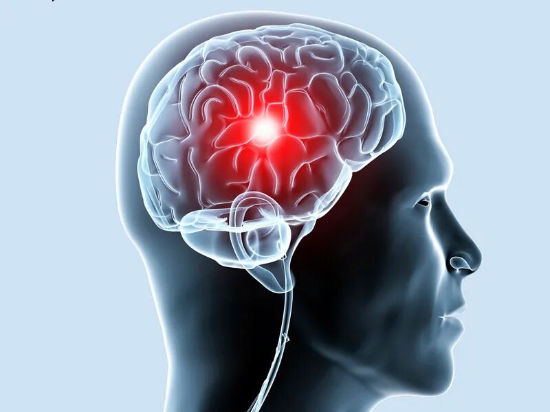 Лечение болезней головного мозга. Ишемия ишемический инсульт мозга. Мозг в голове. Недостаточное кровоснабжение мозга.