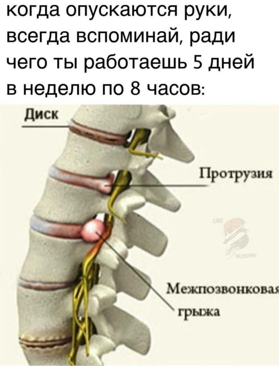 Спинные диски. Протрузии межпозвонковых дисков l1 s1. Что такое протрузия дисков позвоночника поясничного отдела. Протрузия дисков позвоночника 2 3. Позвоночный диск l4-5 протрузия.