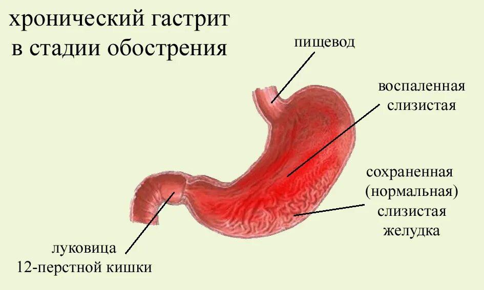 Как восстановить слизистую при гастрите. Поверхностный дуоденит. Воспалительные заболевания слизистой оболочки желудка.