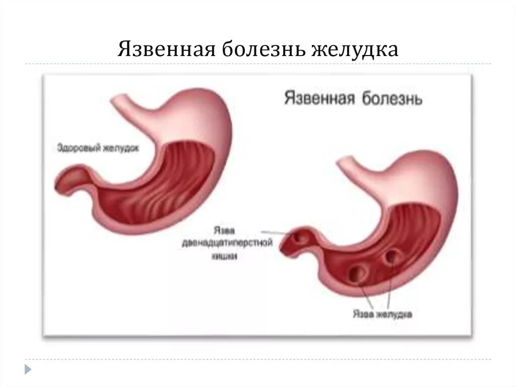 Язва и армия. Язвенная болезнь 12 перстной кишки клинические рекомендации. Язвенная болезнь ДПК клинические рекомендации. Заболевания пищеварительной системы язва. Язвенная болезнь желудка и двенадцатиперстной Кишк.