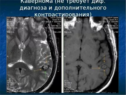 Кавернома головного