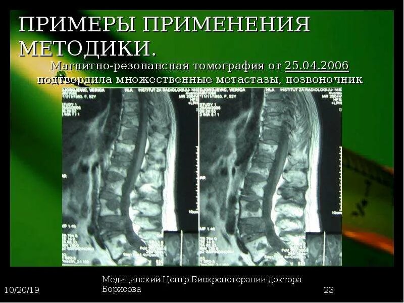 Продолжительность жизни при метастазах. Метастазы в позвоночнике на мрт. Метастазы в позвоночнике на кт. Множественные метастазы в позвоночнике кт. Остеолитические метастазы в позвоночник.