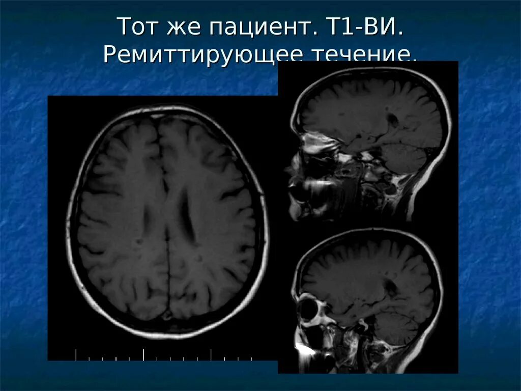 Аксональное демиелинизирующее поражение. Демиелинизирующие заболевания ЦНС. Демиелинизирующие заболевания классификация. Деминилезирующин заболевания. Демиелинизирующие заболевания нервной системы классификация.