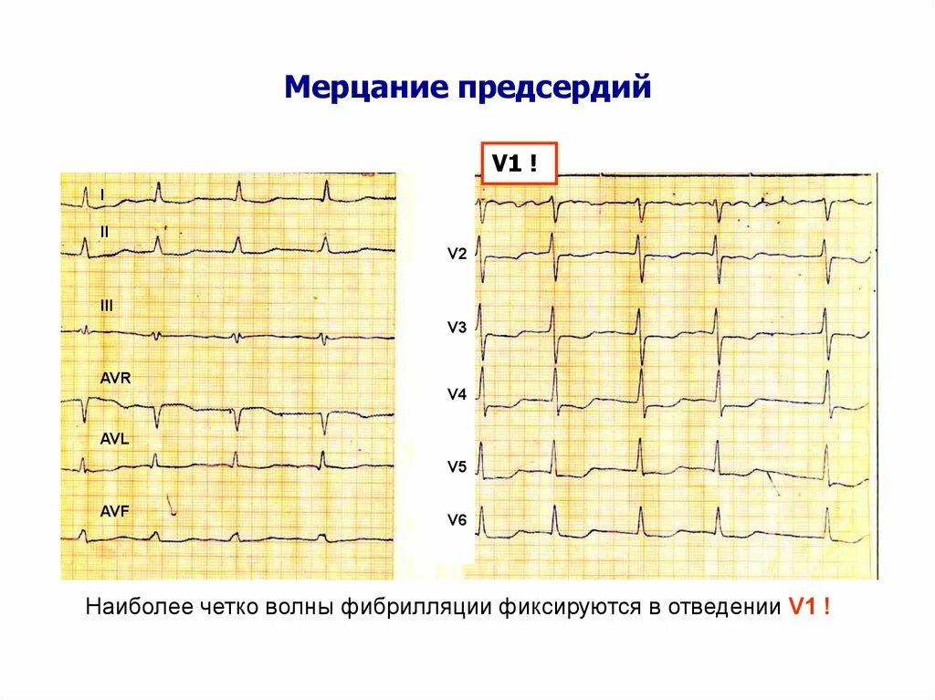 Мерцание предсердий на ЭКГ признаки. Мерцание и трепетание предсердий на ЭКГ. Мерцание предсердийпредсердий. Фибрилляция и мерцание предсердий. Отведение v1 на экг