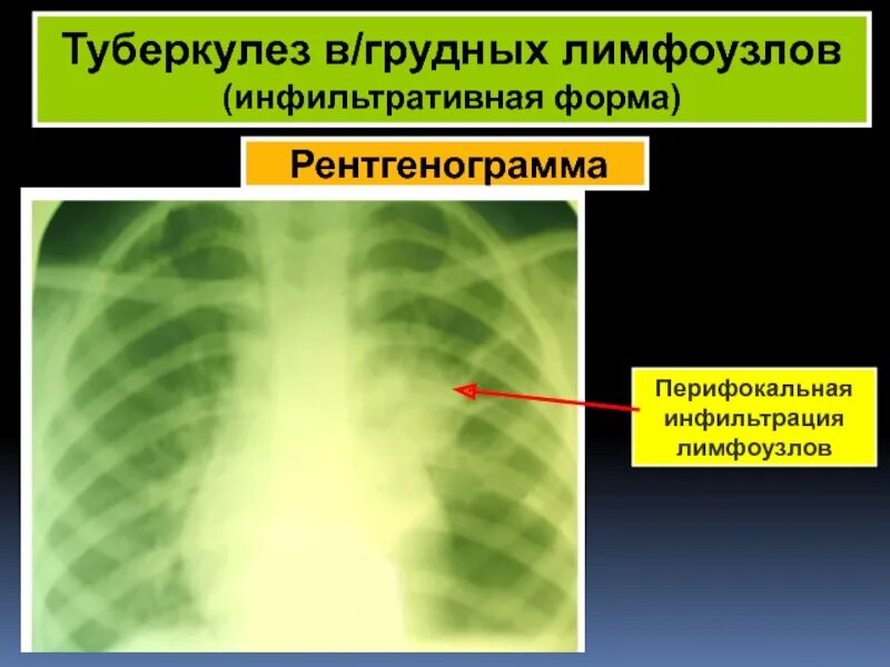 Без перифокальной реакции. Перифокальная инфильтрация это. Перифокальная инфильтрация рентген. Туберкулез внутригрудных лимфатических узлов инфильтративная форма. Перифокальный клеточный инфильтрат.