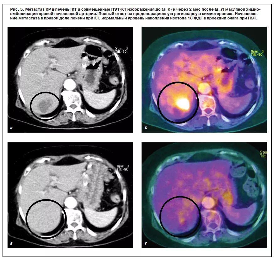 Кт после химиотерапии. Метастазы в печени на ПЭТ кт. Позитронно-эмиссионная томография печени. Метастатические опухоли печени кт. Позитронно-эмиссионная томография опухоли.
