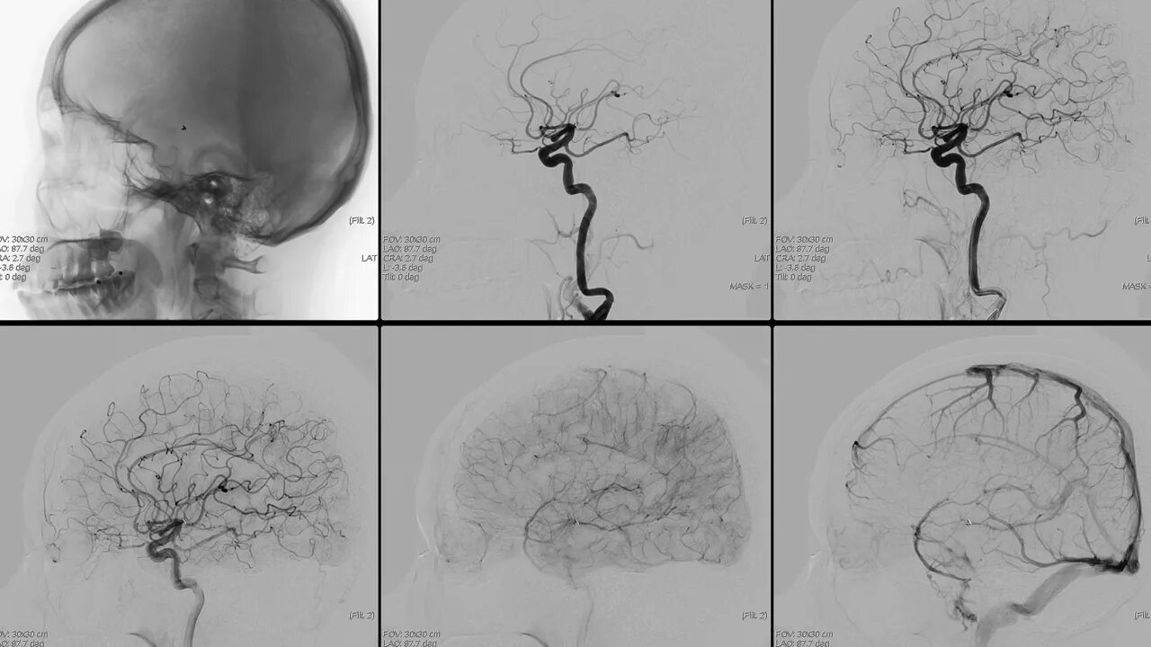Форум аневризма мозга. Ангиография головного мозга аневризма. Селективная церебральная ангиография. Церебральная ангиография сосудов головного мозга. Церебральная субтракционная ангиография.