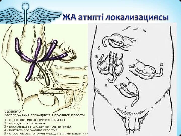 Аппендицит схема расположения Покажет ли КТ аппендицит Признаки аппендицита на КТ
