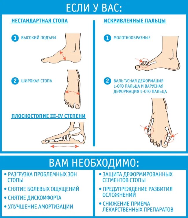 Подъем стопы. Плоскостопие и высокий подъем. Высокий подъем ноги.