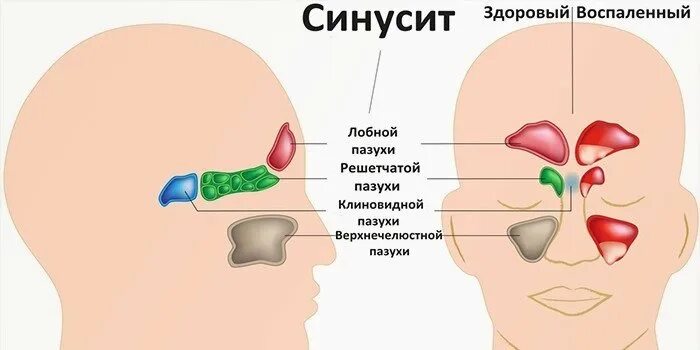 Актиномикоз верхнечелюстной пазухи. Пазухи носа анатомия гайморит. Синусит гайморит фронтит. Болят пазухи. Зеленые сопли при синусите.