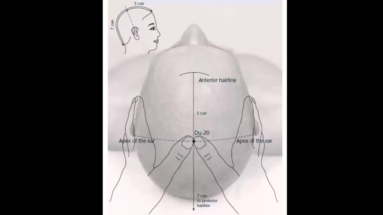 Точка 20 на телефон. Vg20 точка акупунктуры. Бай-Хуэй (GV.20). Бай Хуэй точка акупунктуры. Акупунктура VG 20 бай Хуэй.
