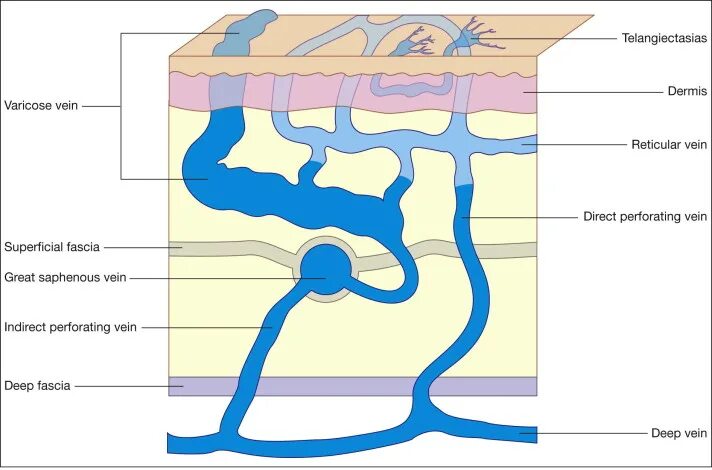Перфорантные вены нижних конечностей. Перфорантные вены нижних конечностей недостаточность клапаны. Перфорантные вены голени. Строение вен нижних конечностей.