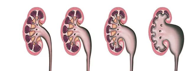 Расширение лоханки гидронефроз. Врожденный гидронефроз почки. Гидронефроз левой почки 2ст. В почечных лоханках собирается