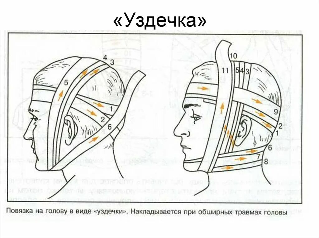 Повязка накладывается при повреждении затылка. Наложение повязки уздечка алгоритм. Чепец уздечка. Повязка уздечка техника наложения. Техника наложения повязки чепец.