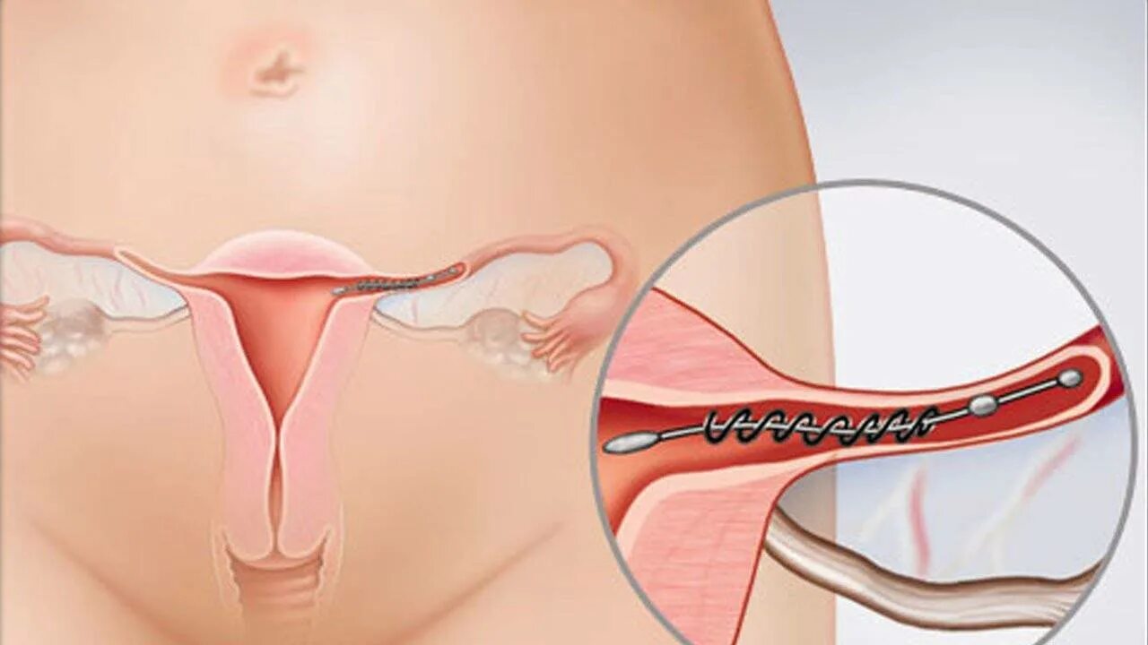 Можно ли забеременеть через перевязанные трубы. Можно ли забеременеть через перевязанные трубы. Можно ли забеременеть через перевязанные трубы. Возможна ли беременность без труб маточных естественным путем. Лапароскопическая операция перевязка маточных труб.