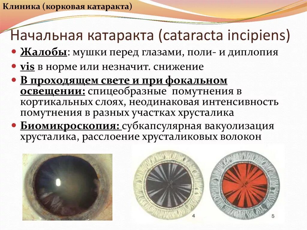 Начальная старческая катаракта. - Кортикальная (корковая) катаракта. Незрелая корковая катаракта. Начальная возрастная катаракта ou. Начальная ядерная катаракта.