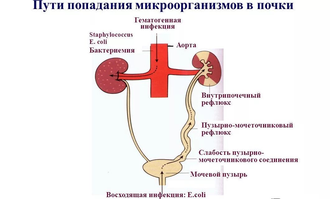 Хронический пиелонефрит с рефлюксом. Пузырно-мочеточникового рефлюкса. Мочевыделительной системы мочевой пузырь. Заболевания мочевыделительной системы пиелонефрит. Заболевания органов мочевыделительной системы у детей.